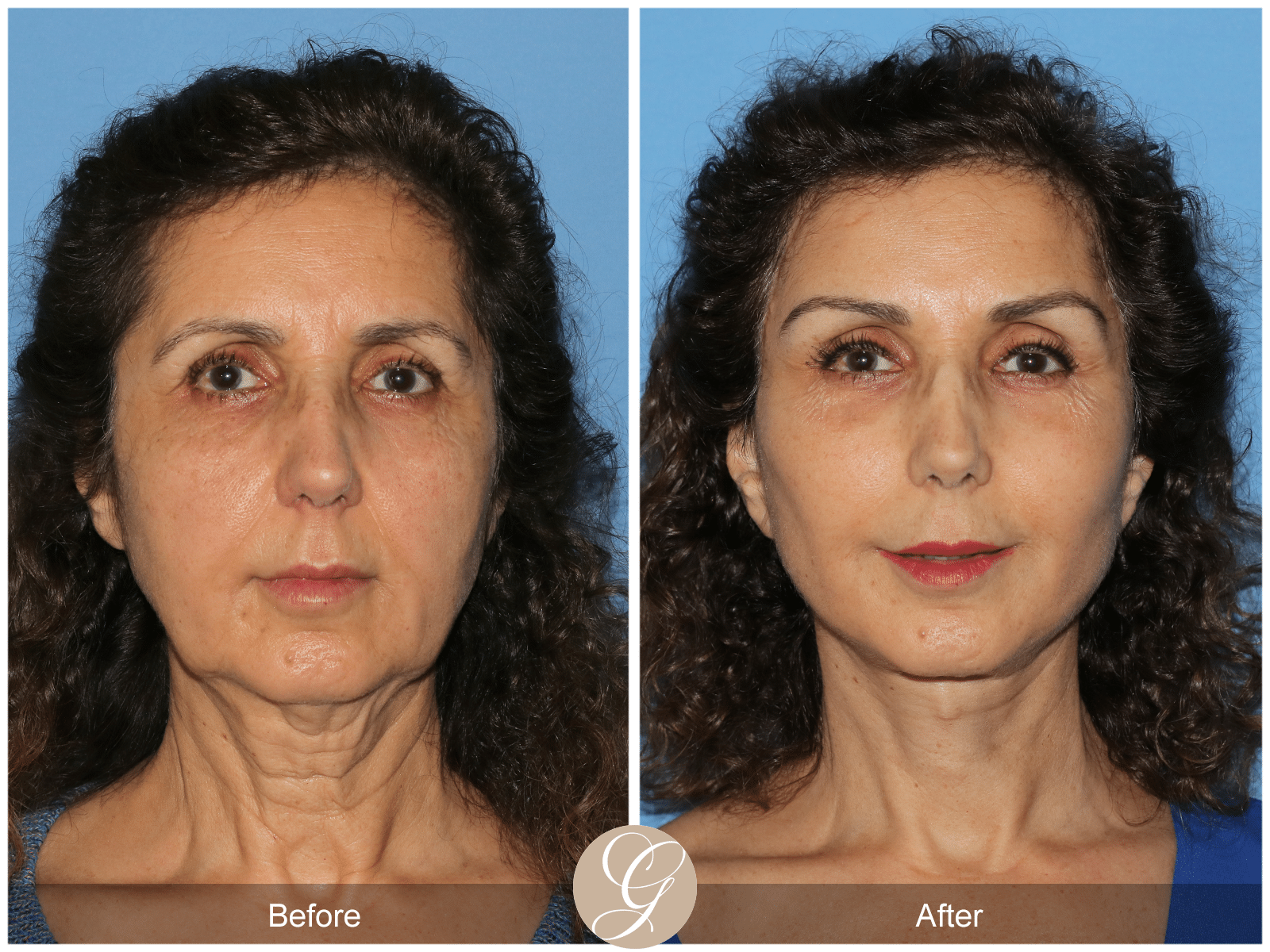Vertical Facelift Case 3 Image