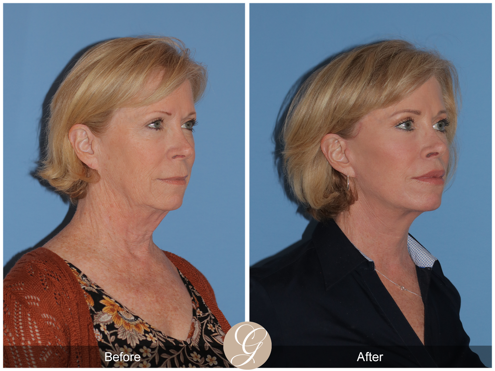 Preservation Lift Case 17 Image