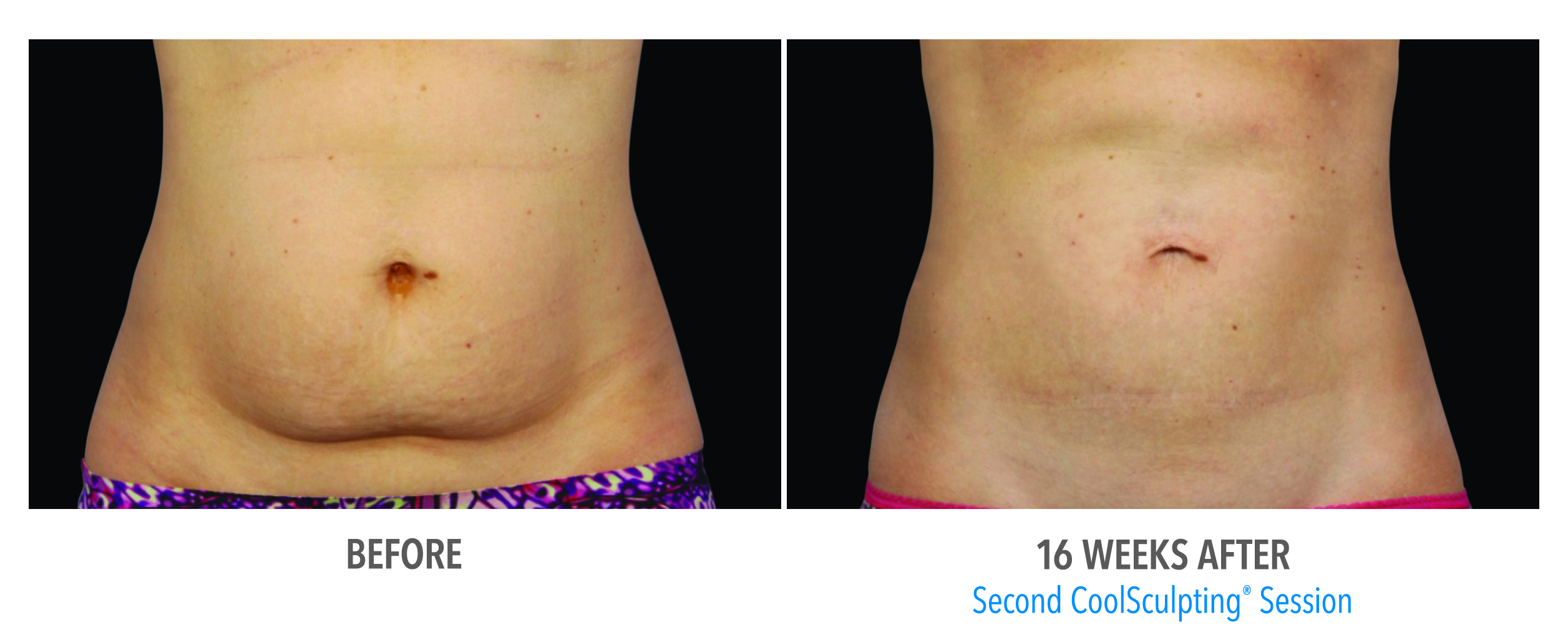 Coolsculpting Case 9 Image