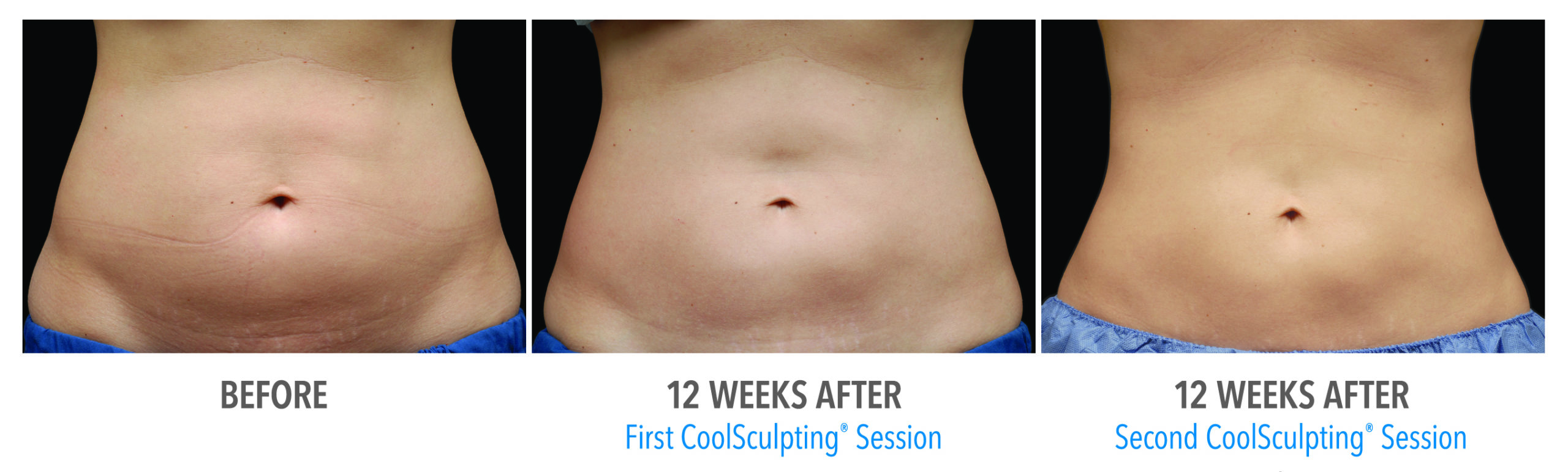 Coolsculpting Case 5 Image