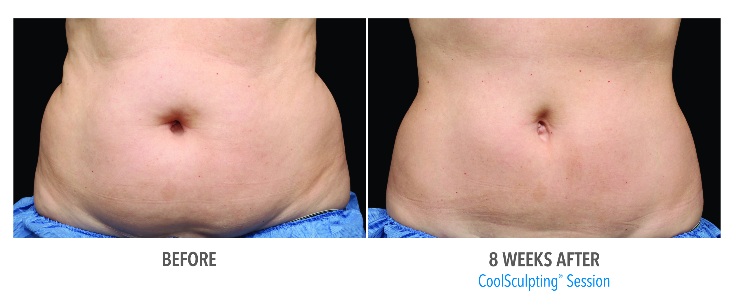 Coolsculpting Case 4 Image