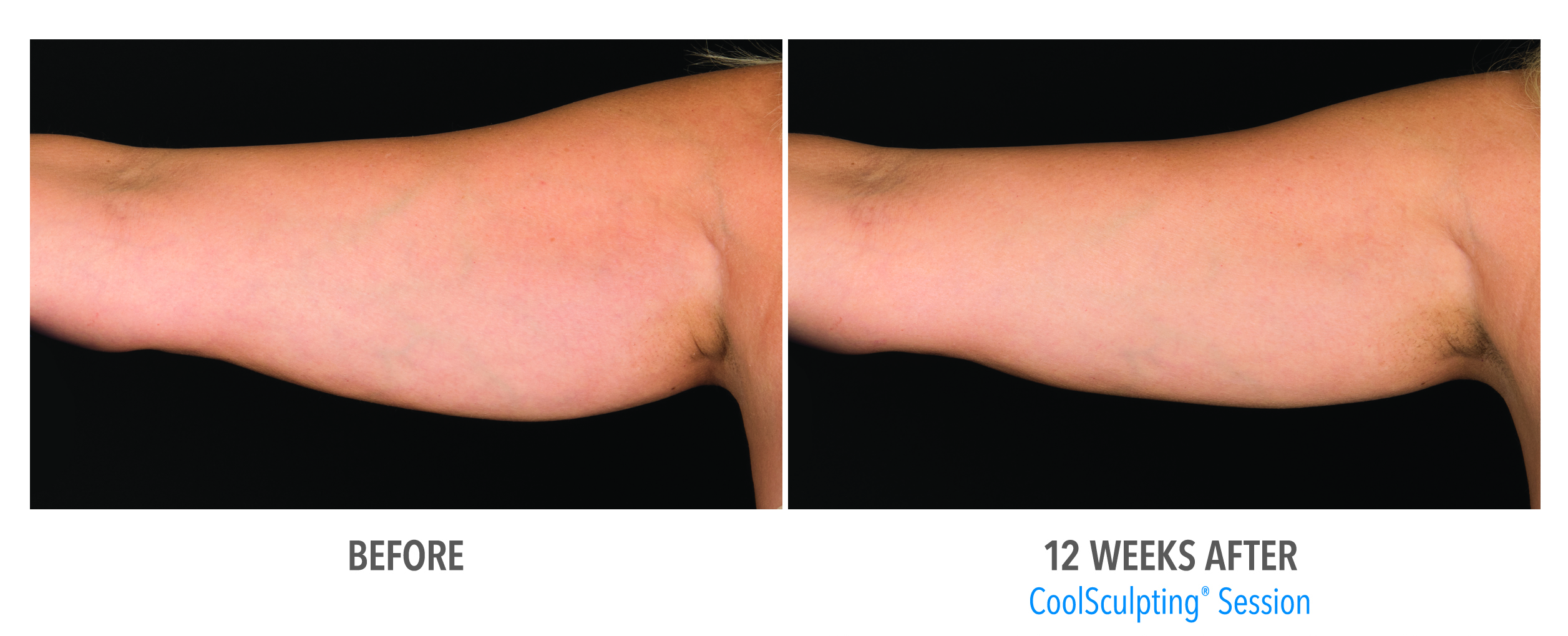Coolsculpting Case 3 Image