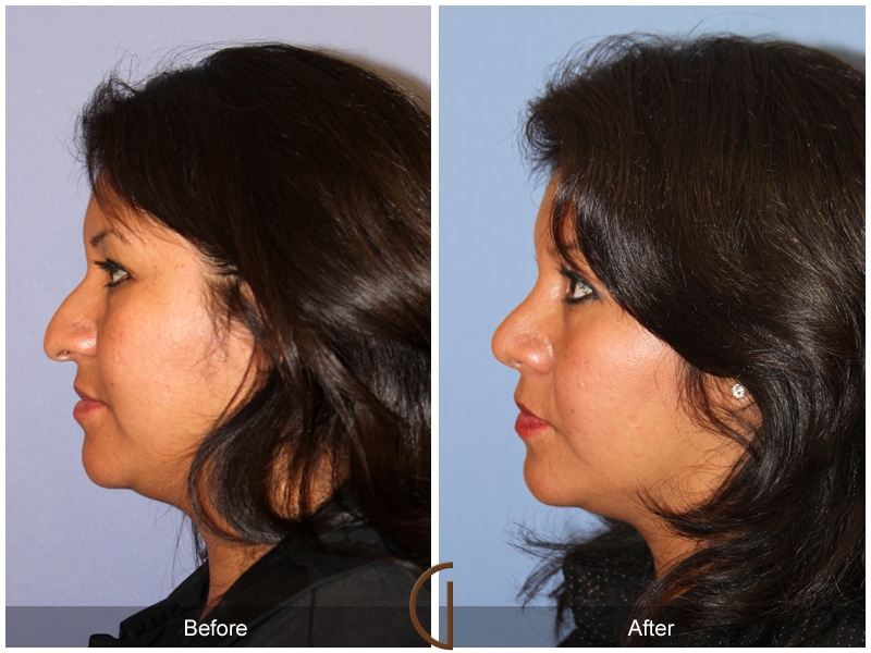 Ethnic Rhinoplasty 101 Image