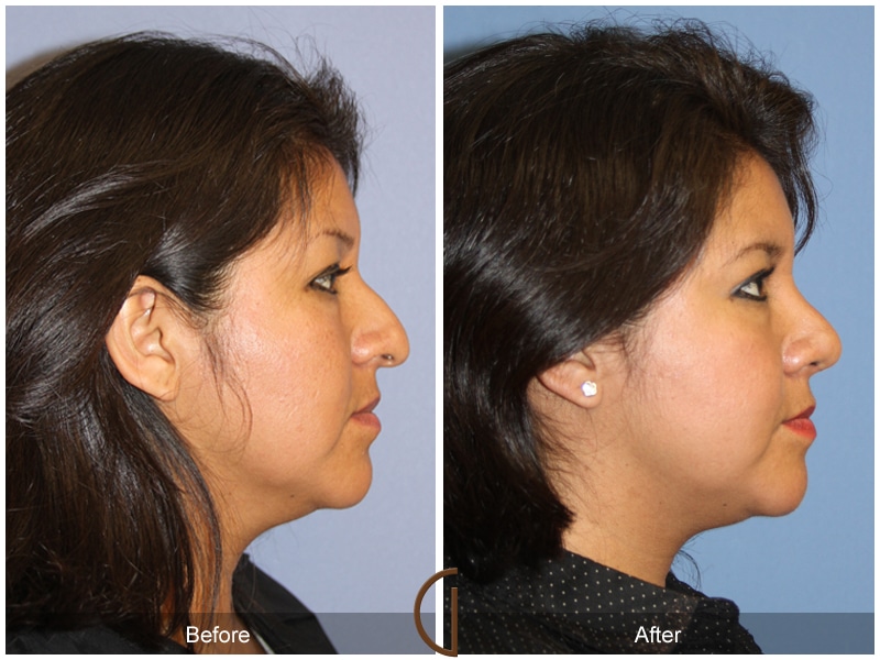 Ethnic Rhinoplasty 101 Image
