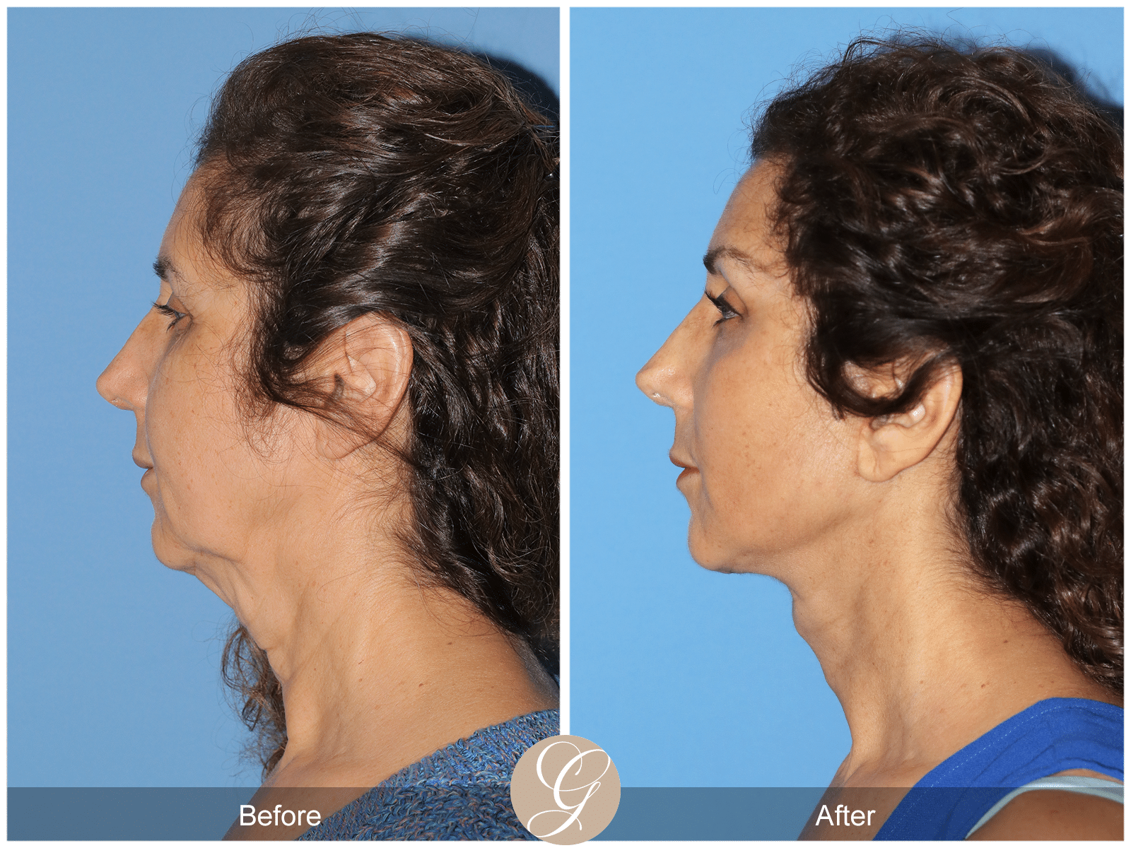 Vertical Facelift Case 3 Image