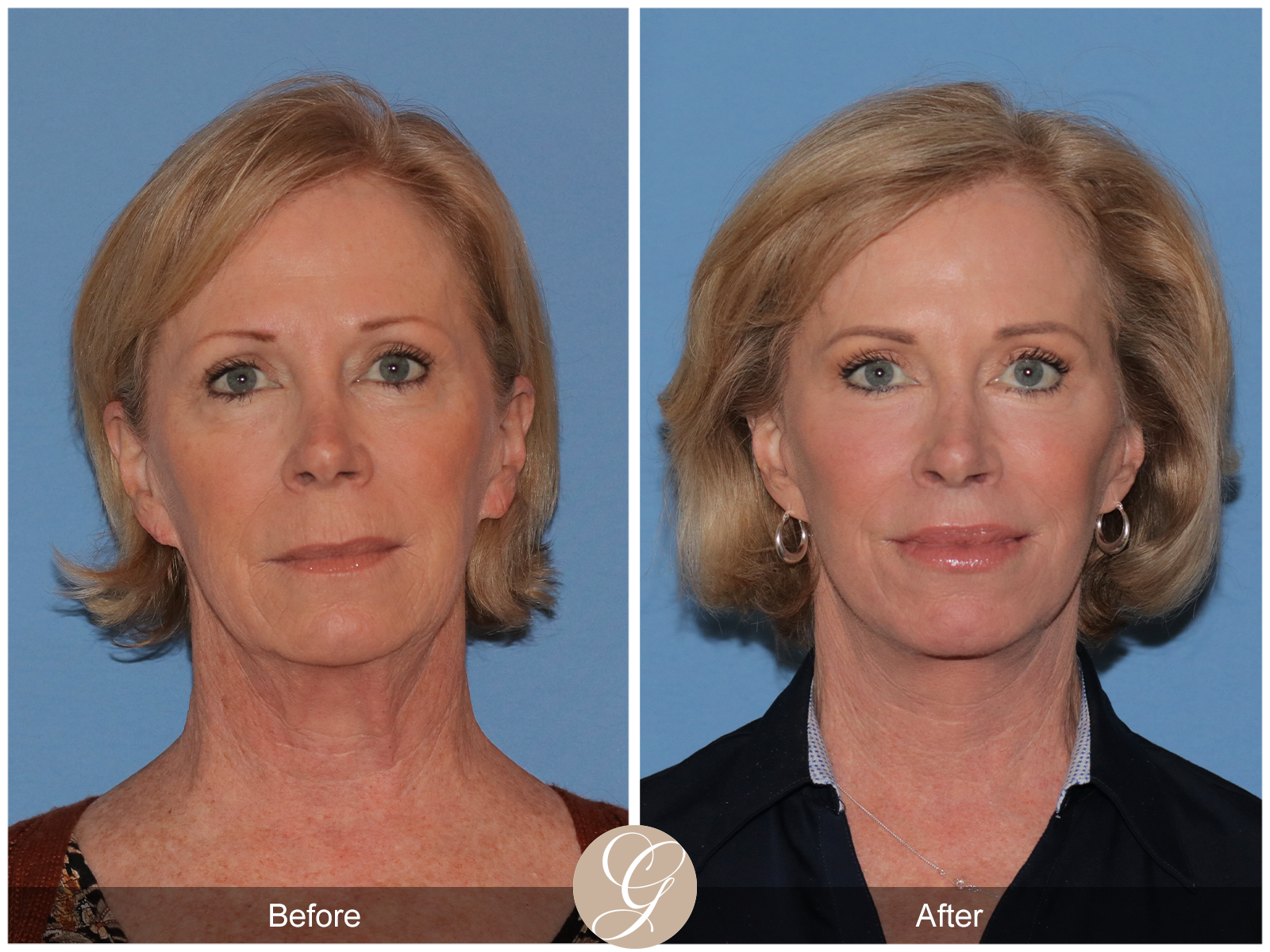 Preservation Lift Case 17 Image