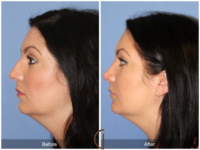 Rhinoplasty 108 Image