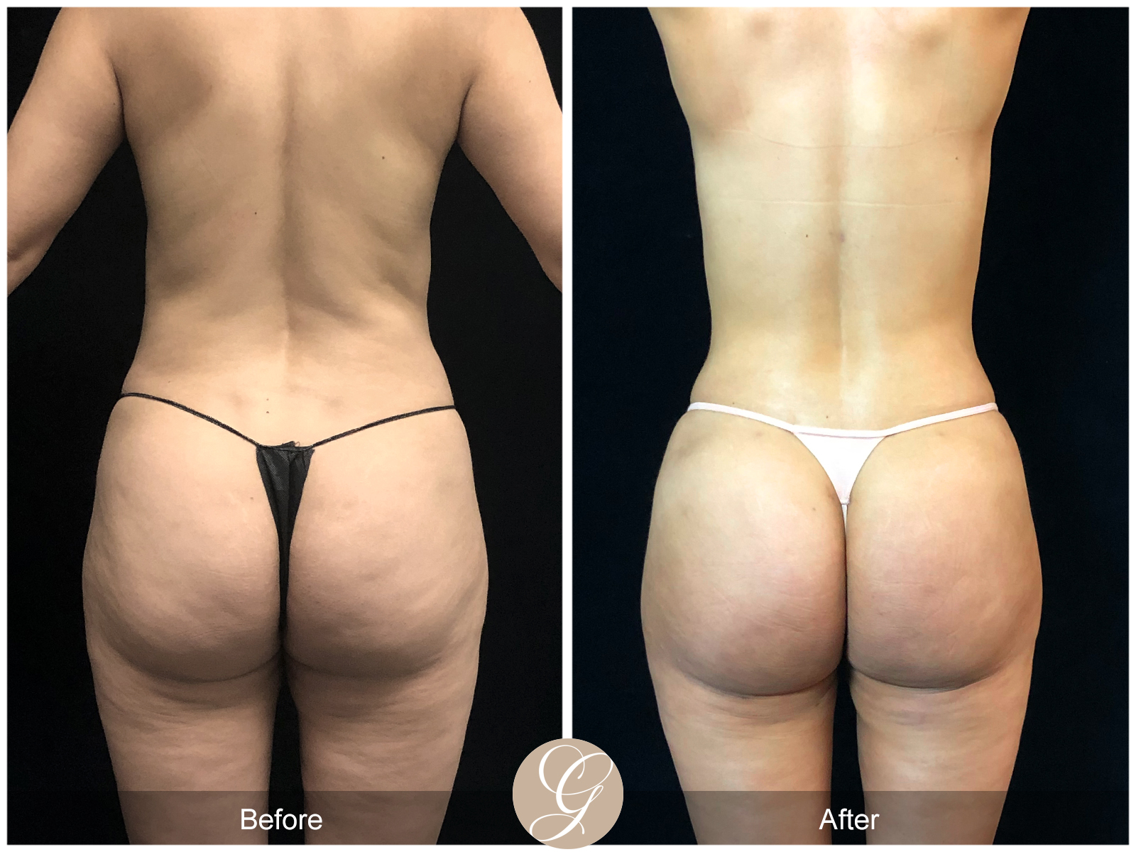 VASER 360 HIGH DEFINITION BODY SCULPTING PT12 Image
