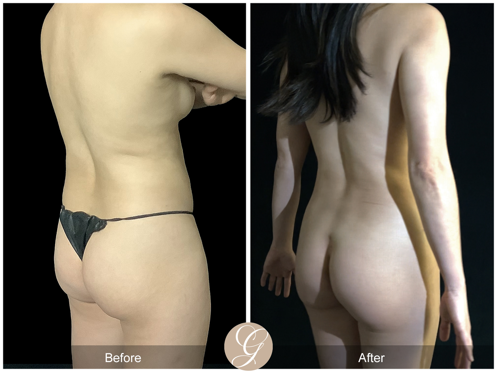 VASER 360 HIGH DEFINITION BODY SCULPTING PT11 Image