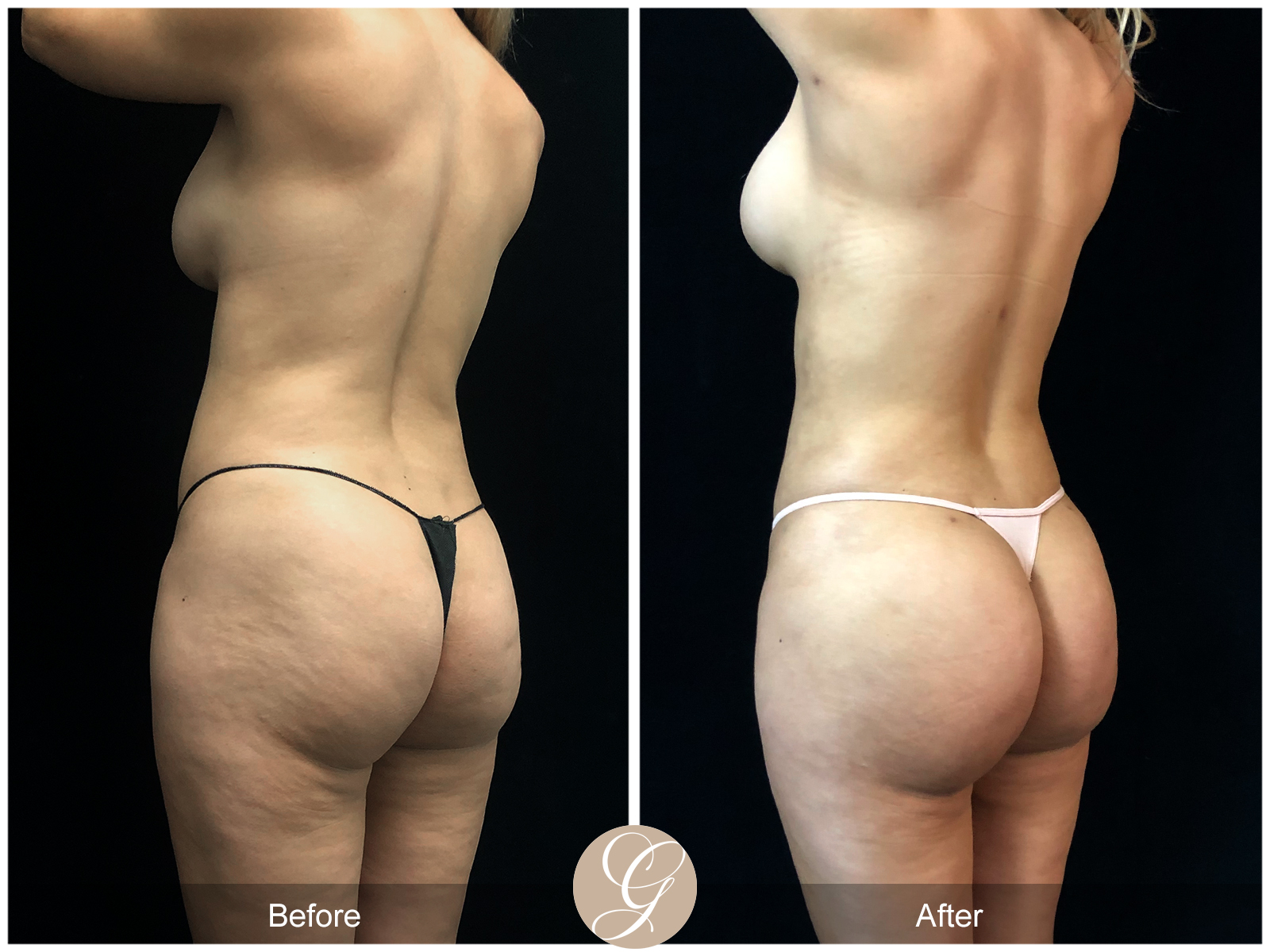 VASER 360 HIGH DEFINITION BODY SCULPTING PT12 Image