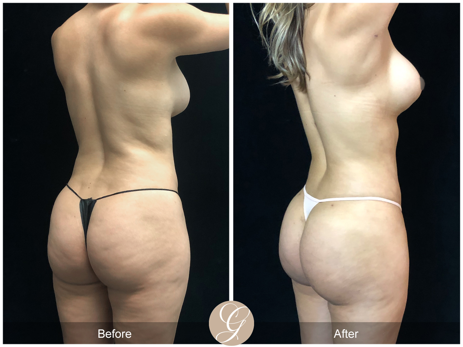 VASER 360 HIGH DEFINITION BODY SCULPTING PT12 Image