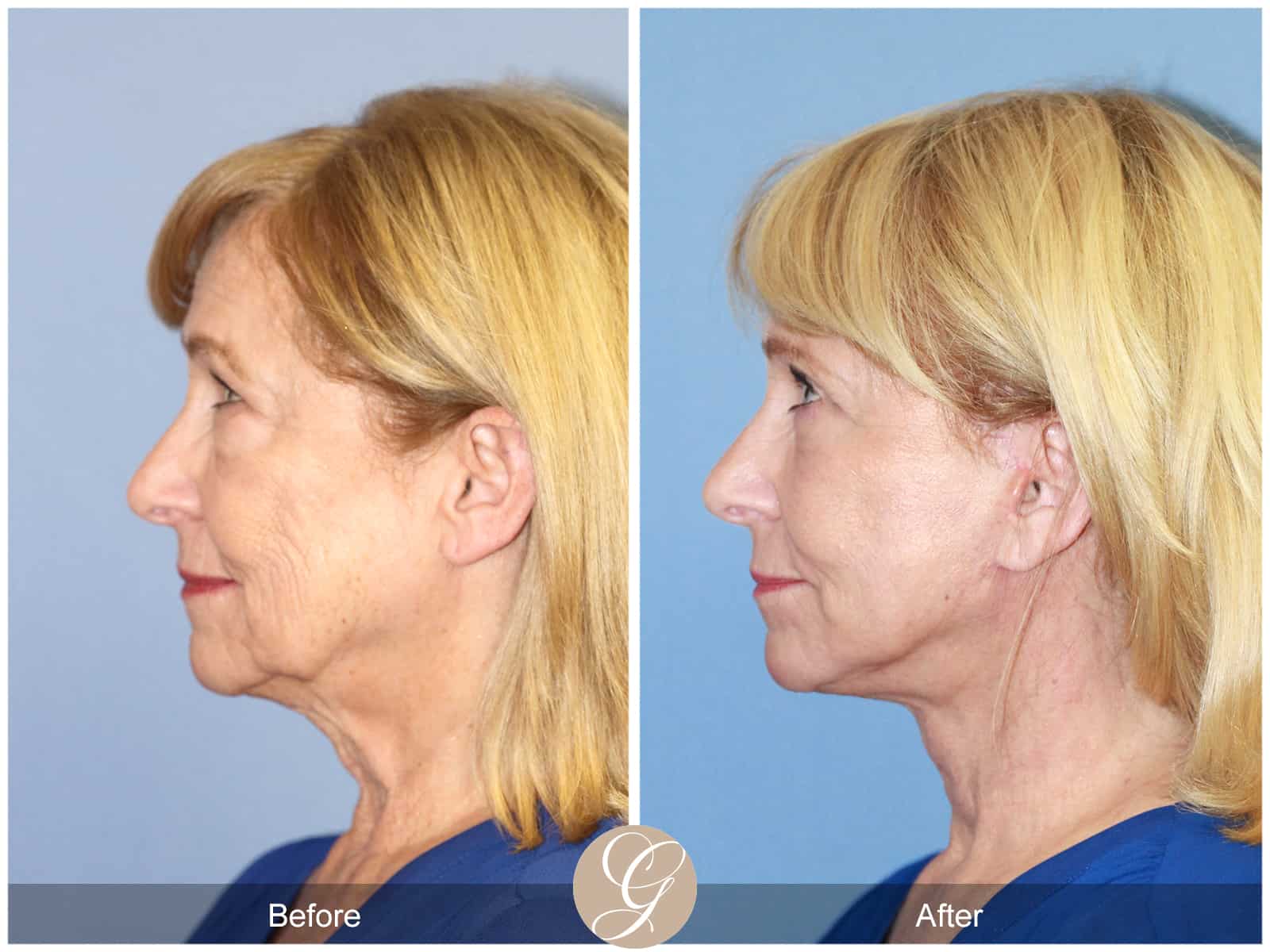 Neck Lift- 413 Image