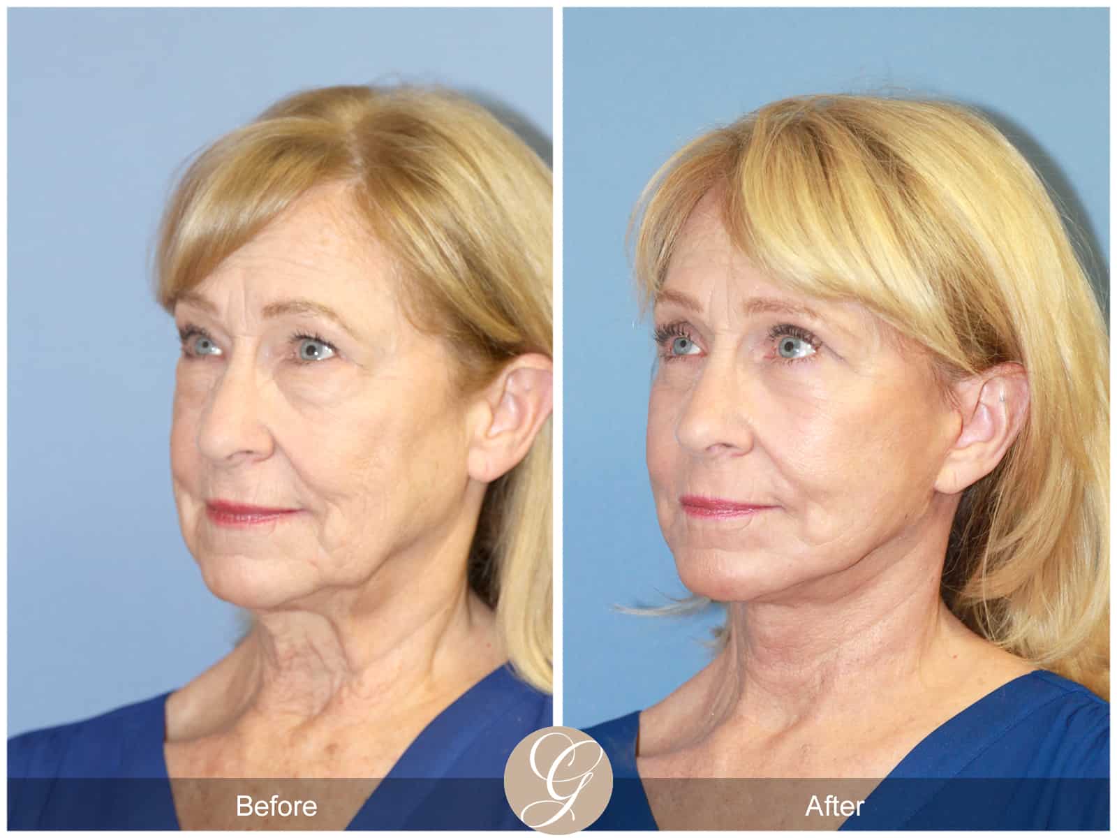 Neck Lift- 413 Image