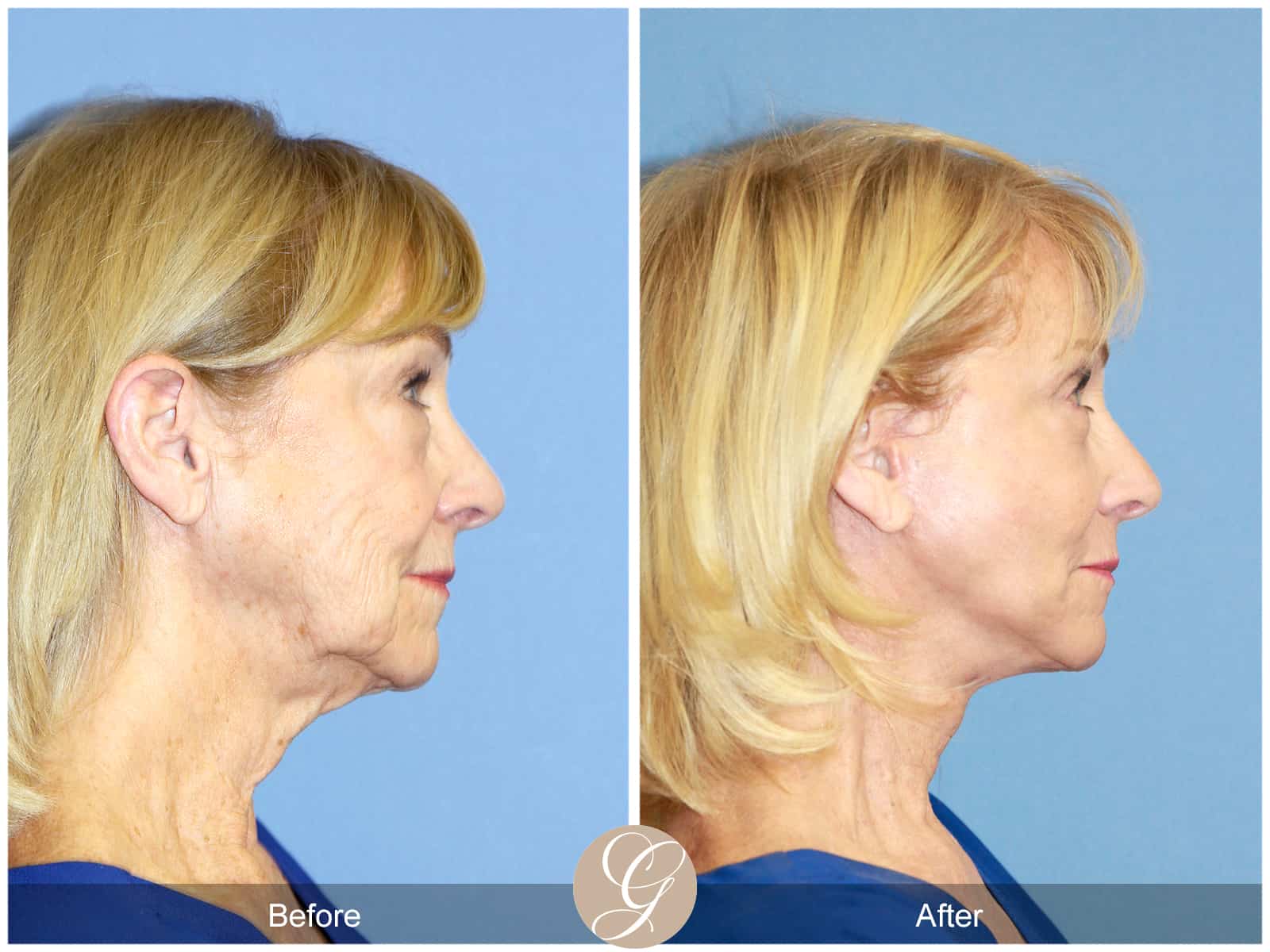 Neck Lift- 413 Image
