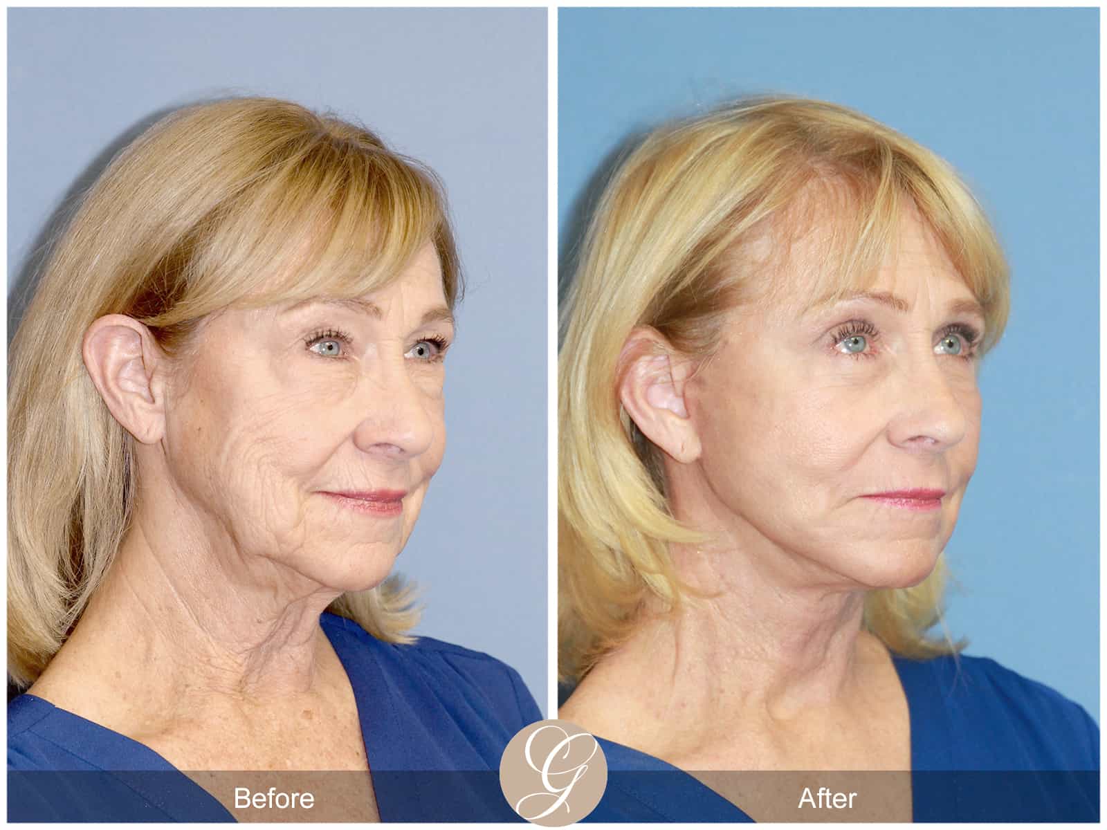 Neck Lift- 413 Image