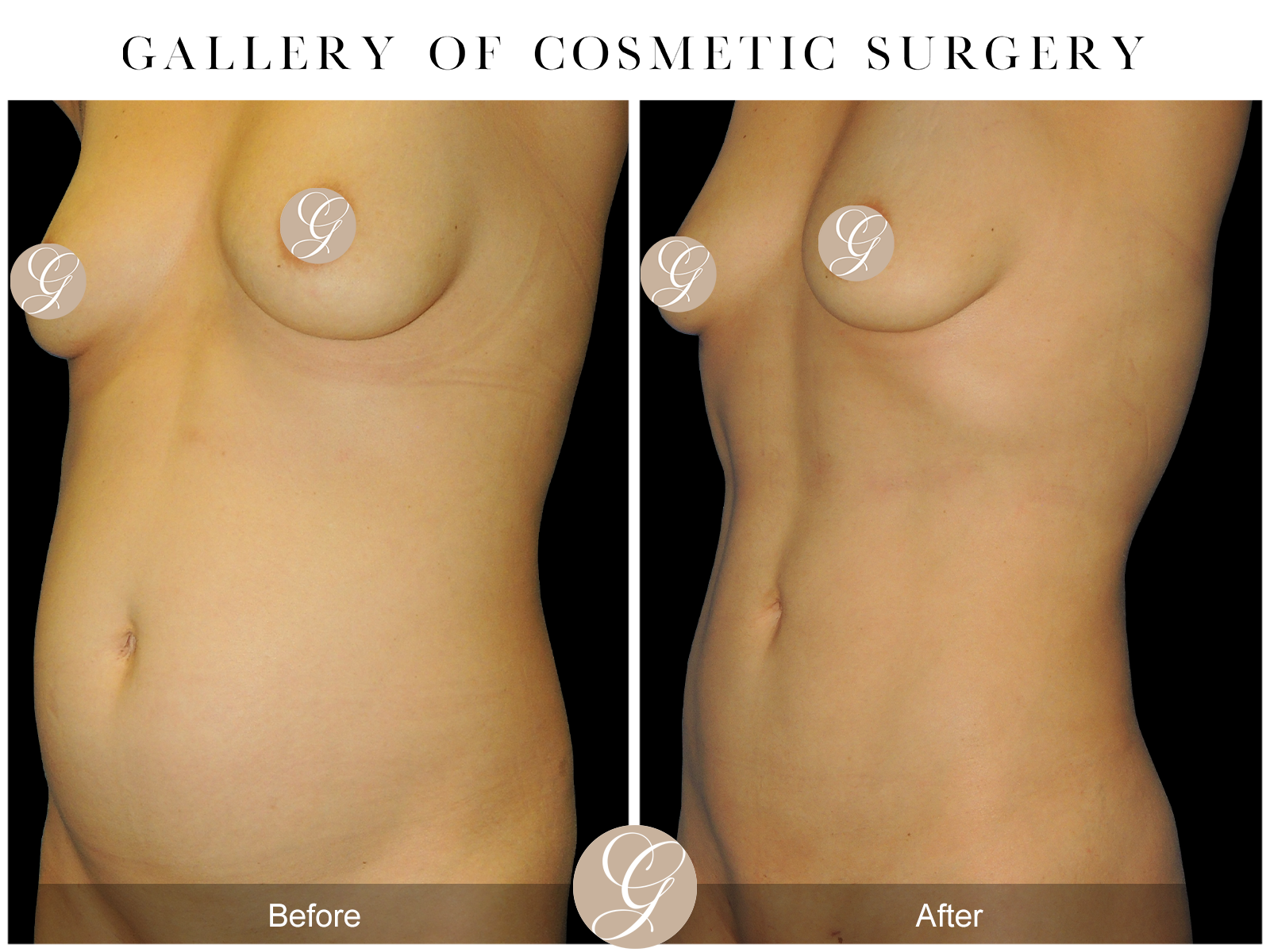 VASER 360 HIGH DEFINITION BODY SCULPTING PT6 Image