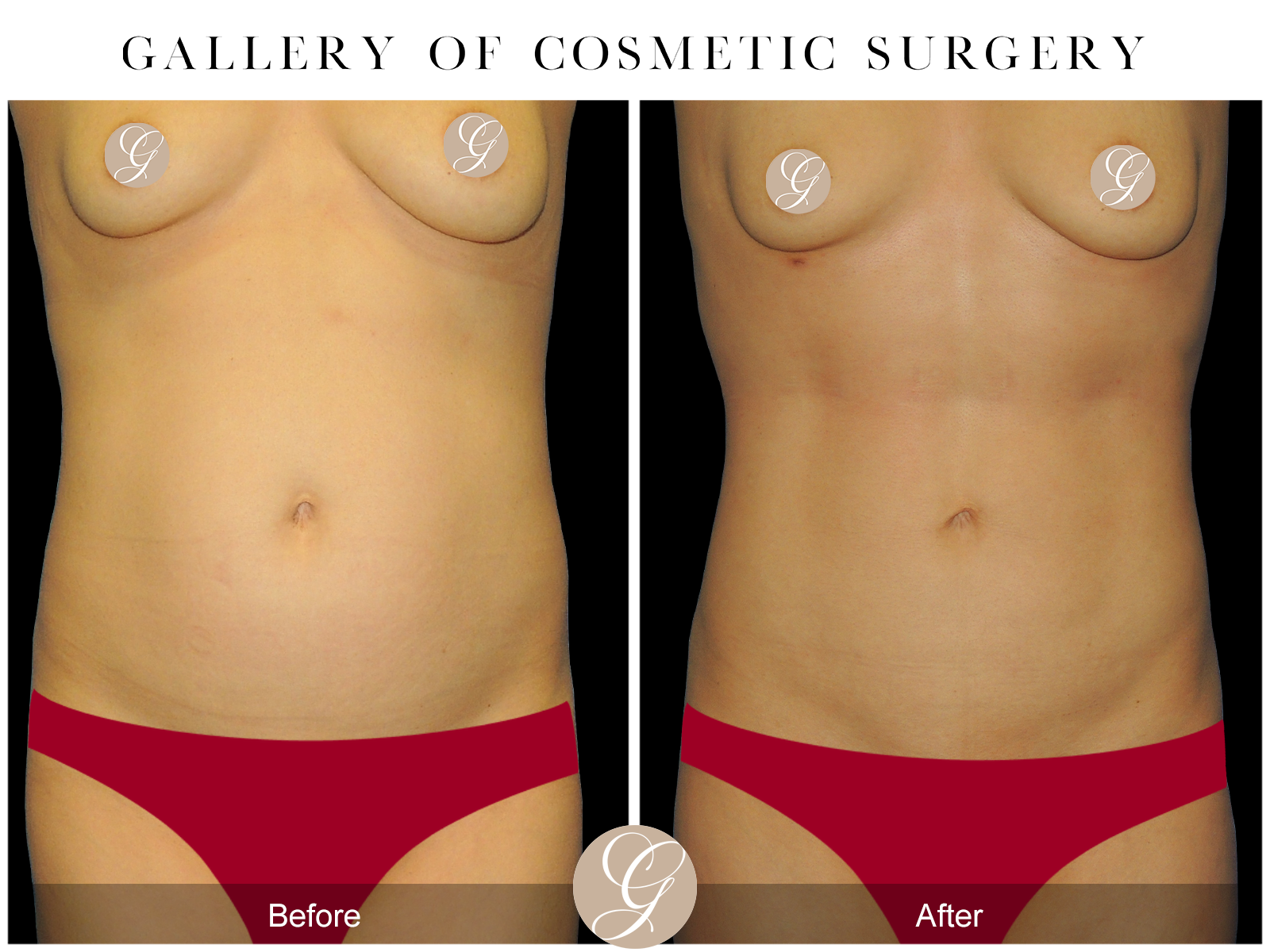 VASER 360 HIGH DEFINITION BODY SCULPTING PT6 Image