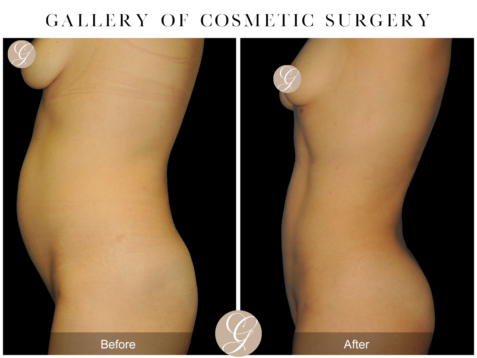 VASER 360 HIGH DEFINITION BODY SCULPTING PT6 Image