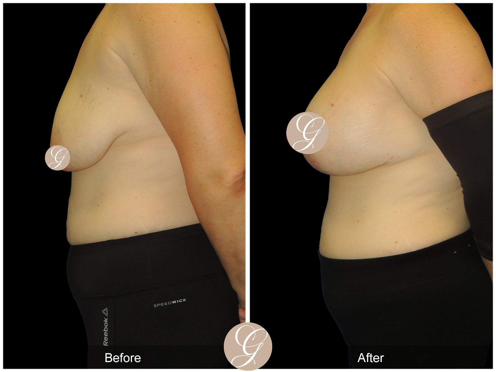 Breast Augmentation Lift (Mastopexy) PT2 Image