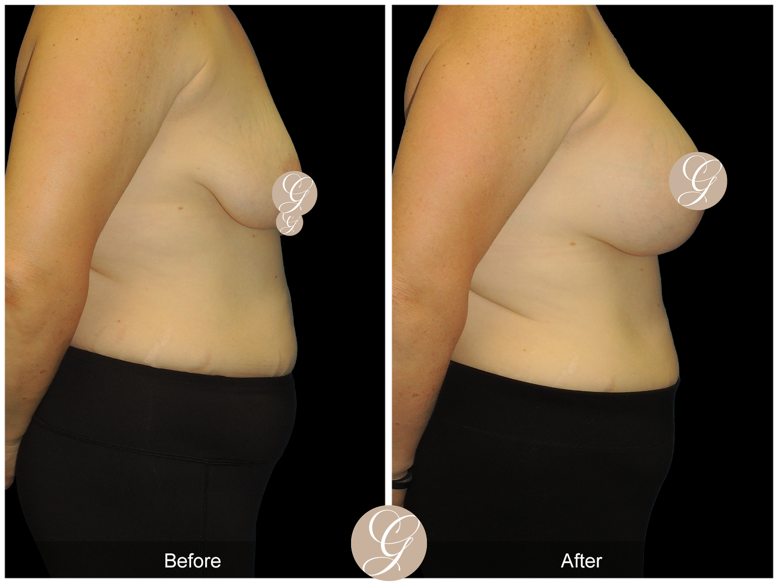 Breast Augmentation Lift (Mastopexy) PT2 Image