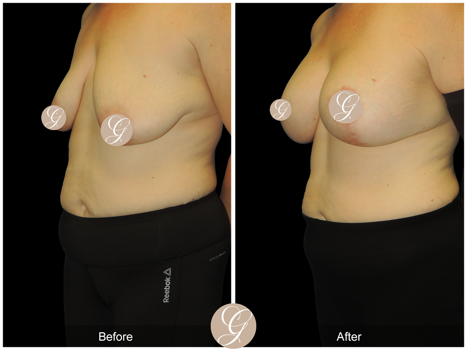 Breast Augmentation Lift (Mastopexy) PT2 Image