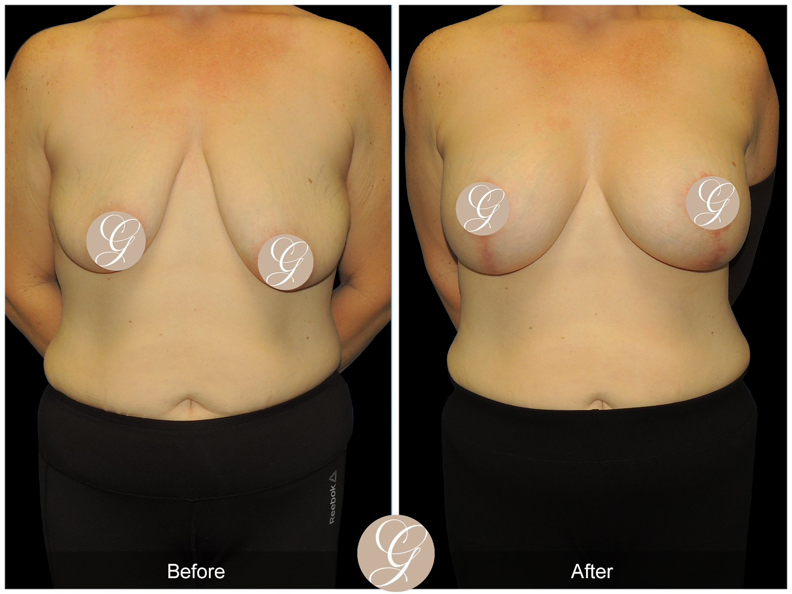 Breast Augmentation Lift (Mastopexy) PT2 Image