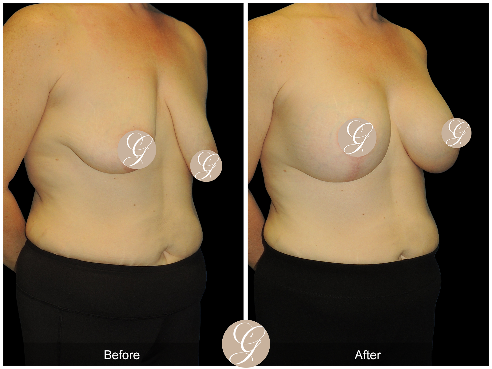 Breast Augmentation Lift (Mastopexy) PT2 Image