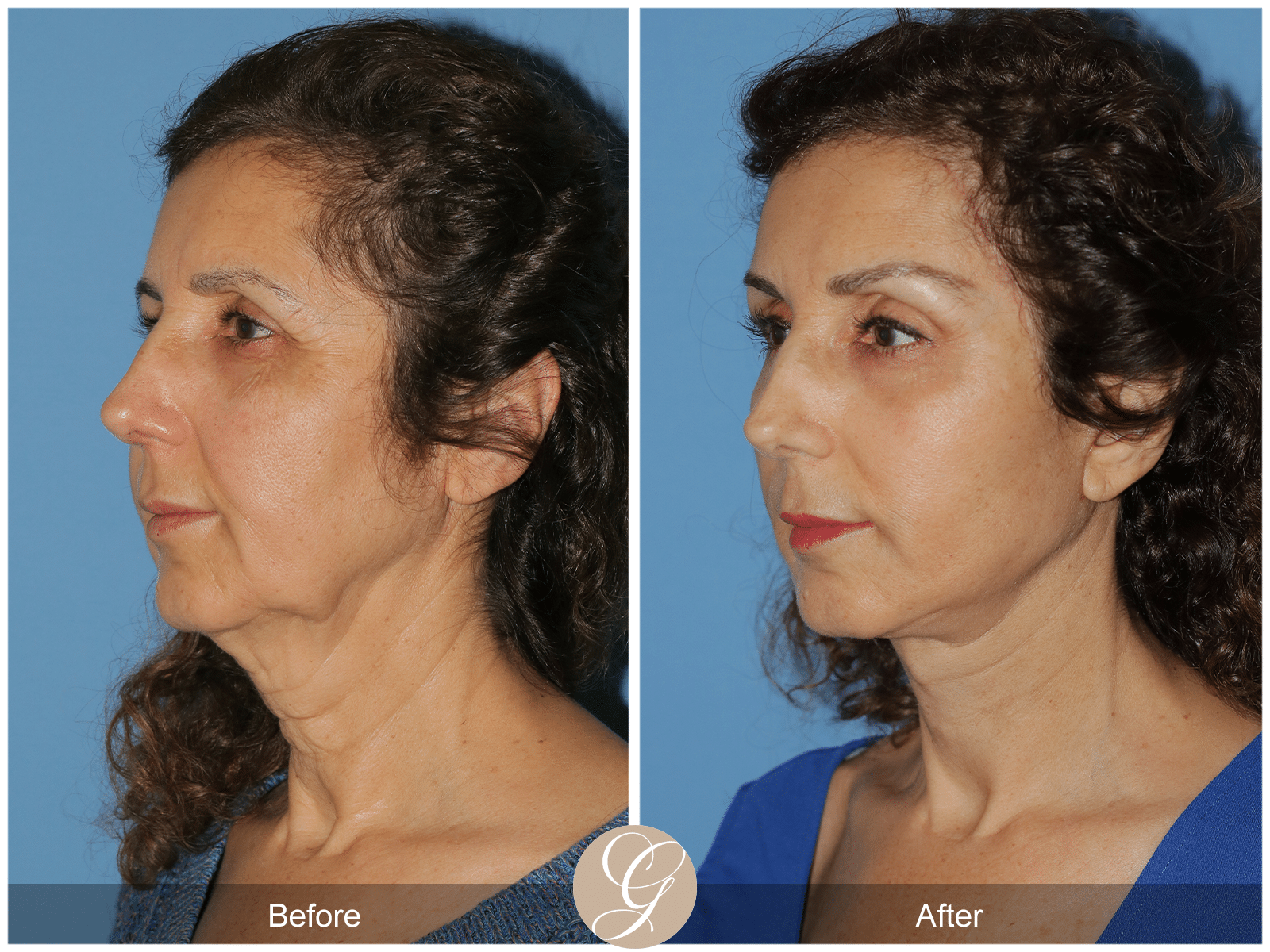 Vertical Facelift Case 3 Image