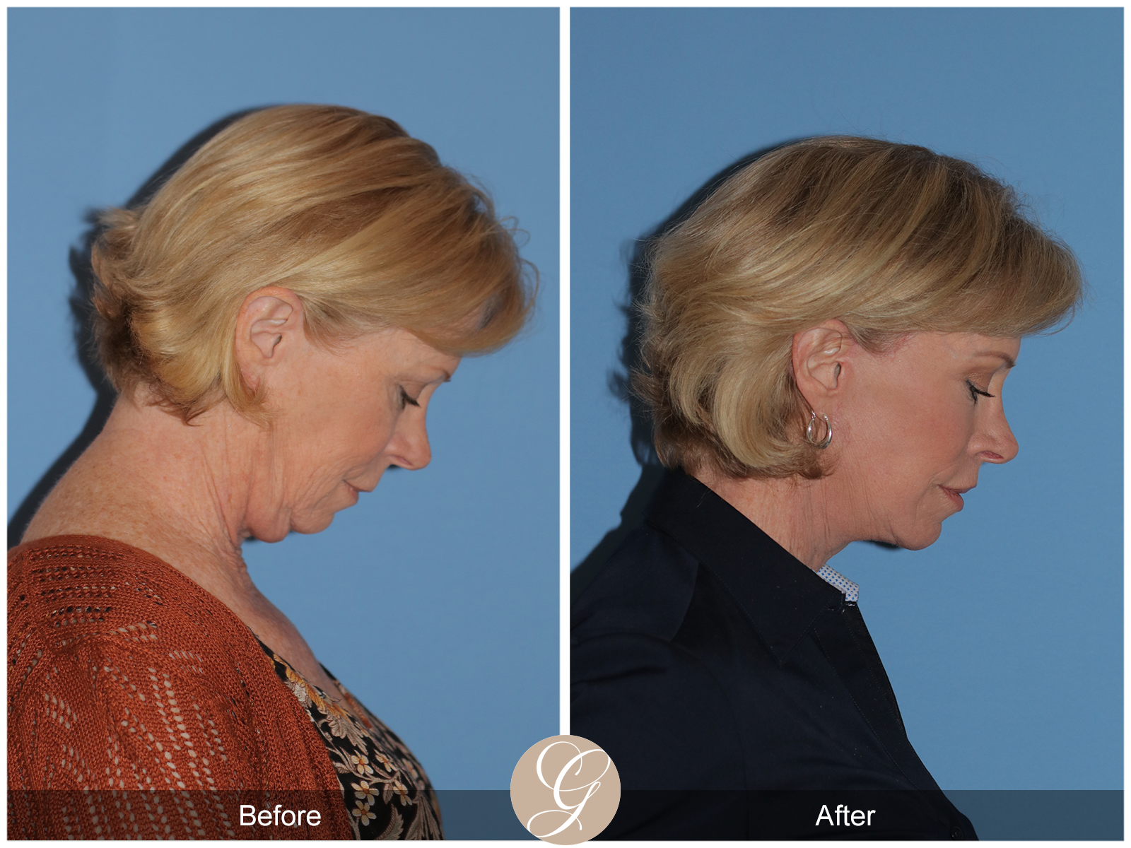 Preservation Lift Case 17 Image