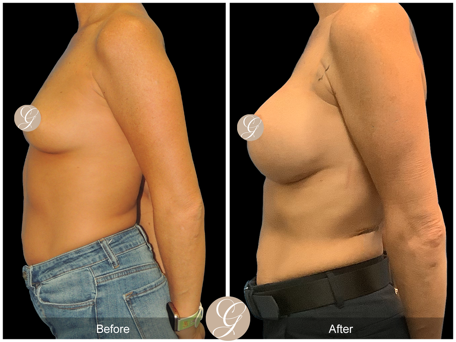 Breast Augmentation PT9 Image
