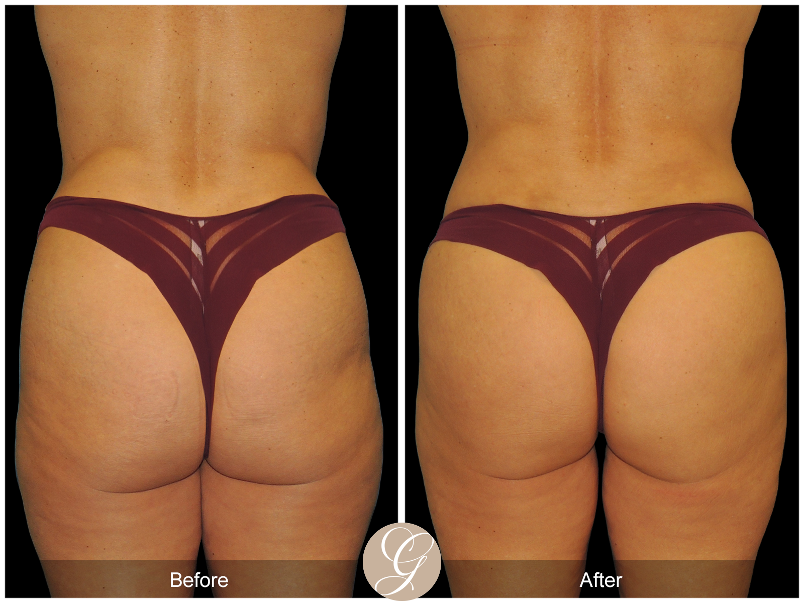 VASER 360 HIGH DEFINITION BODY SCULPTING PT9 Image