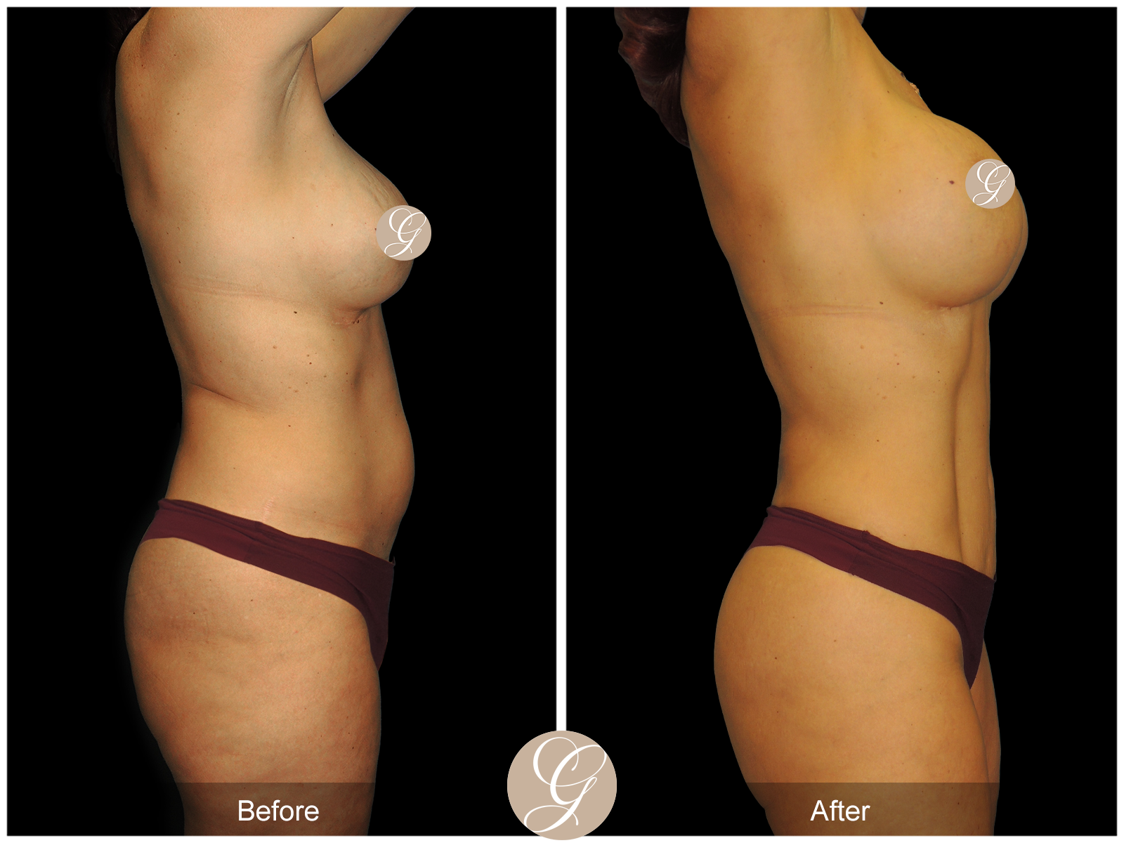 VASER 360 HIGH DEFINITION BODY SCULPTING PT9 Image