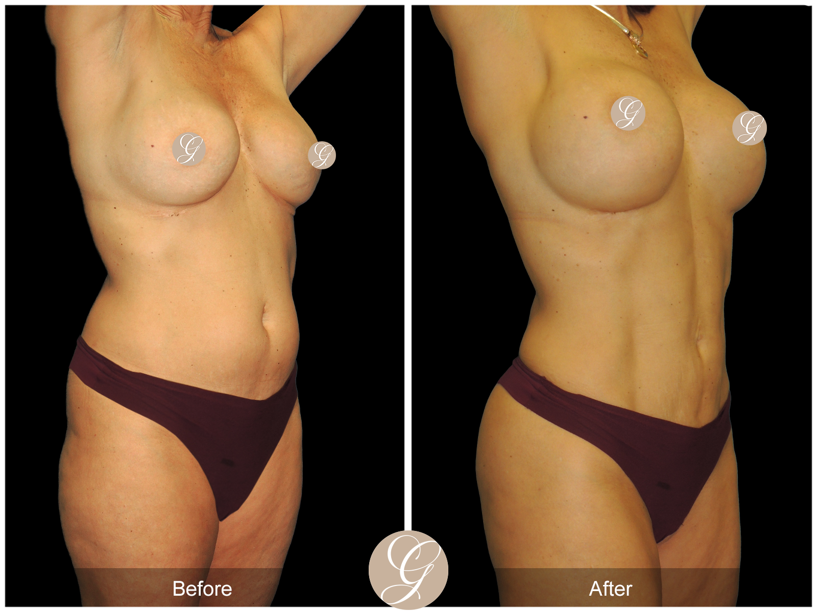 VASER 360 HIGH DEFINITION BODY SCULPTING PT9 Image