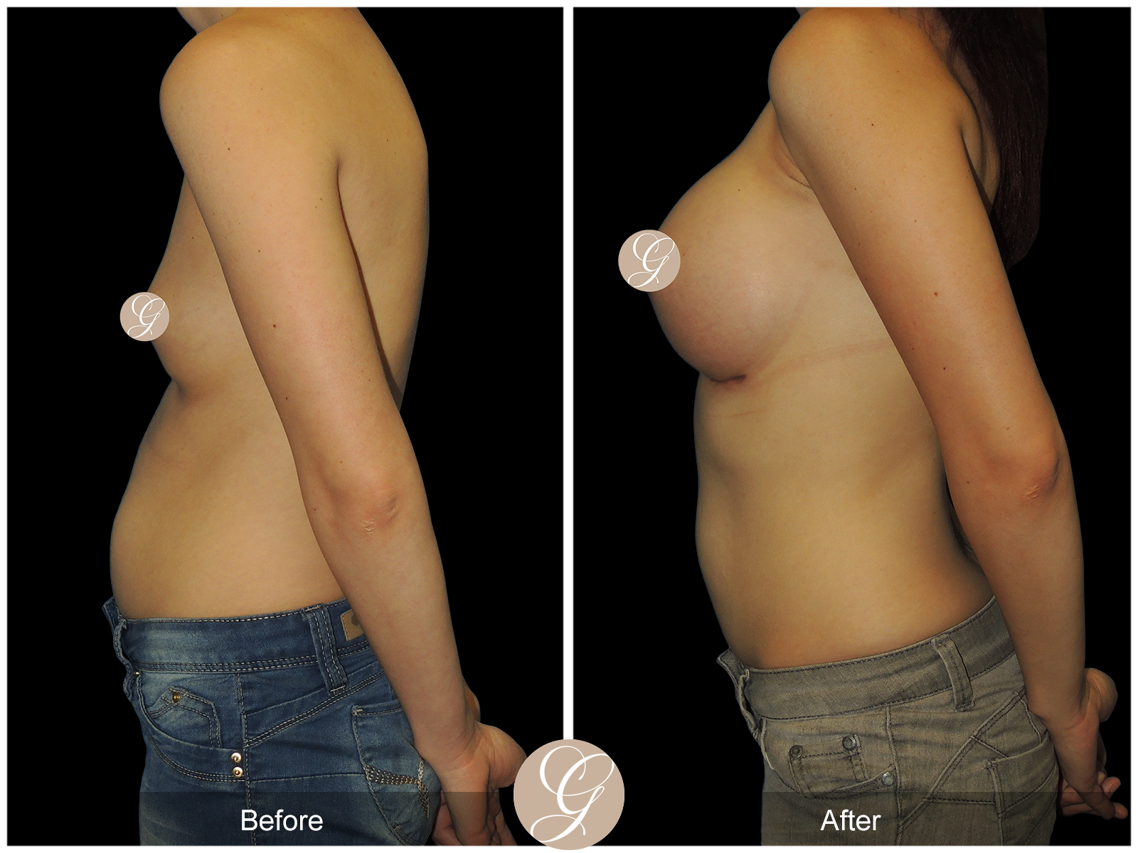 Breast Augmentation PT8 Image