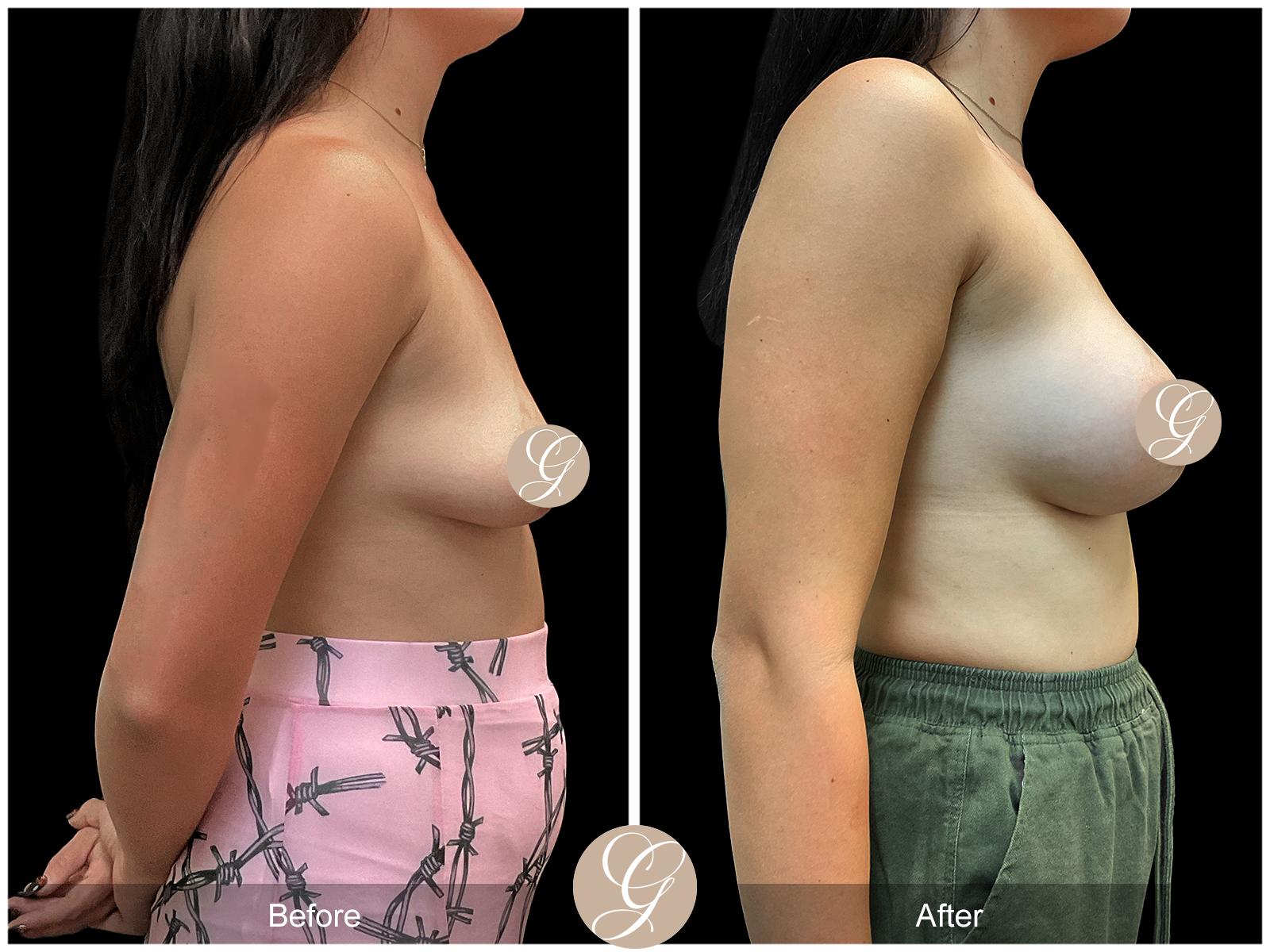 Breast Augmentation PT1 Image