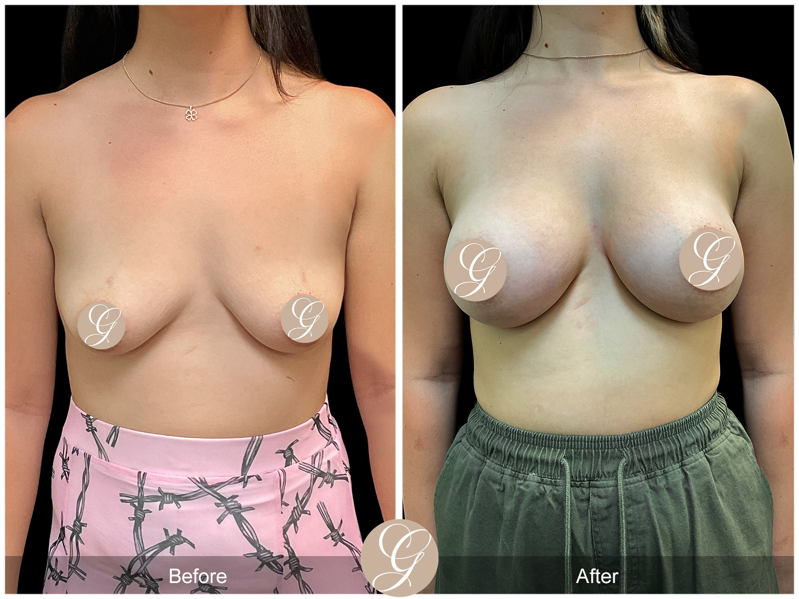 Breast Augmentation PT1 Image