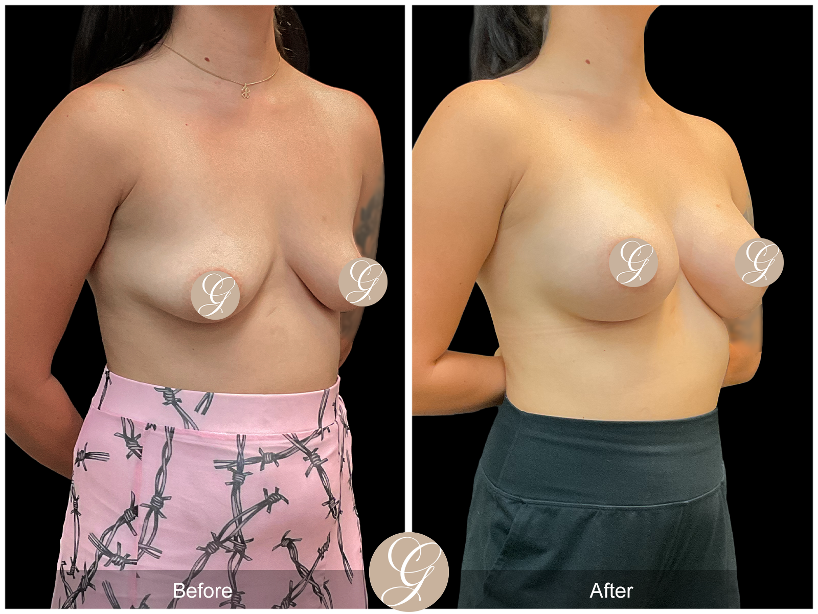 Breast Augmentation PT1 Image