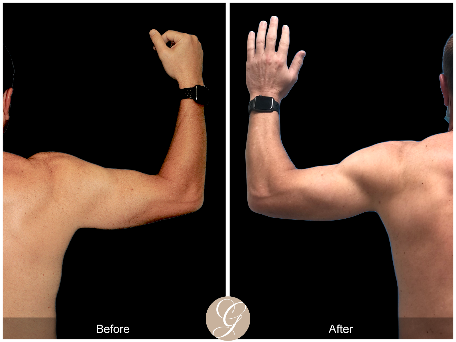 Gynecomastia PT3 Image