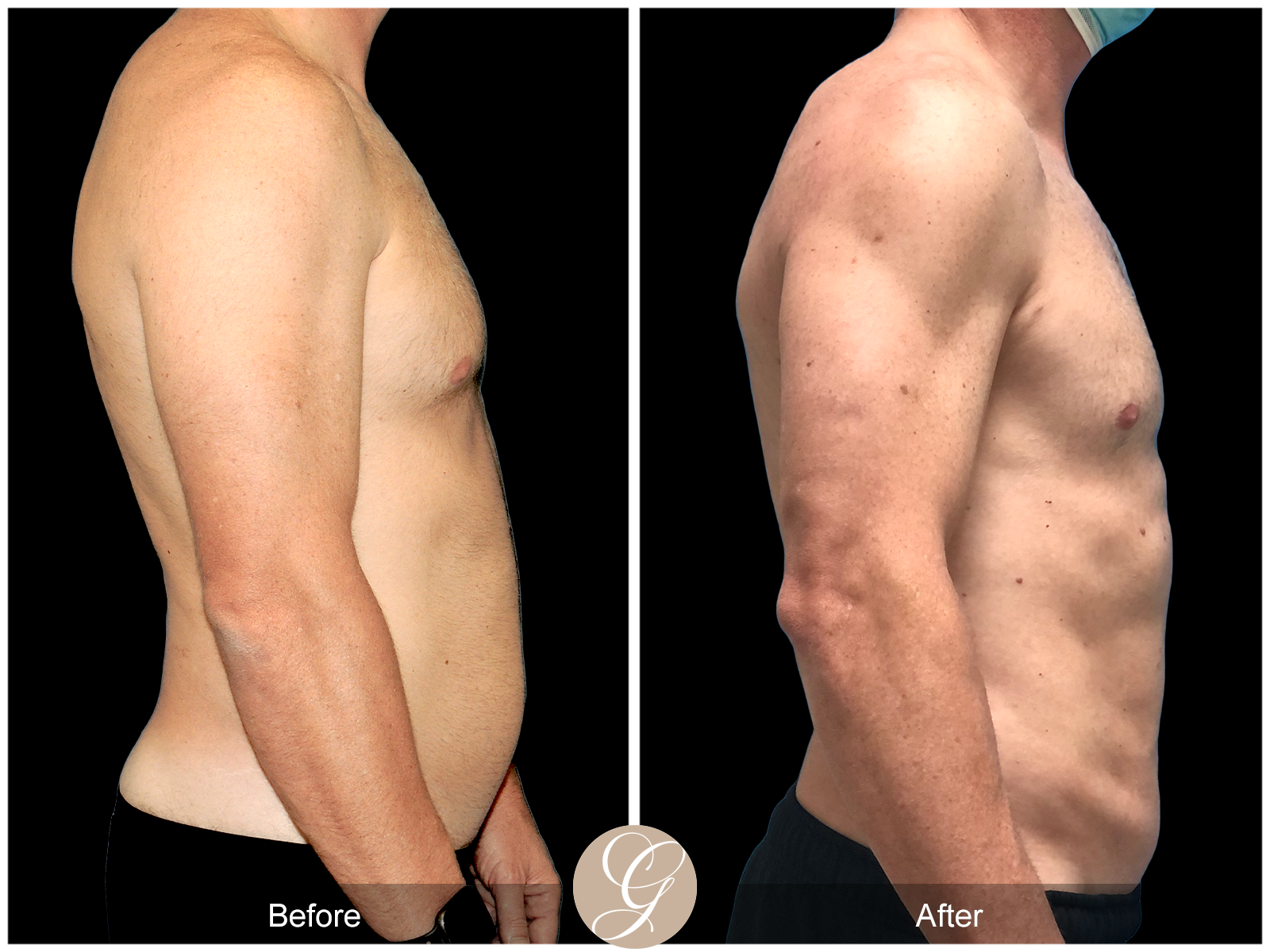 VASER High Definition Surgery for Men PT1 Image