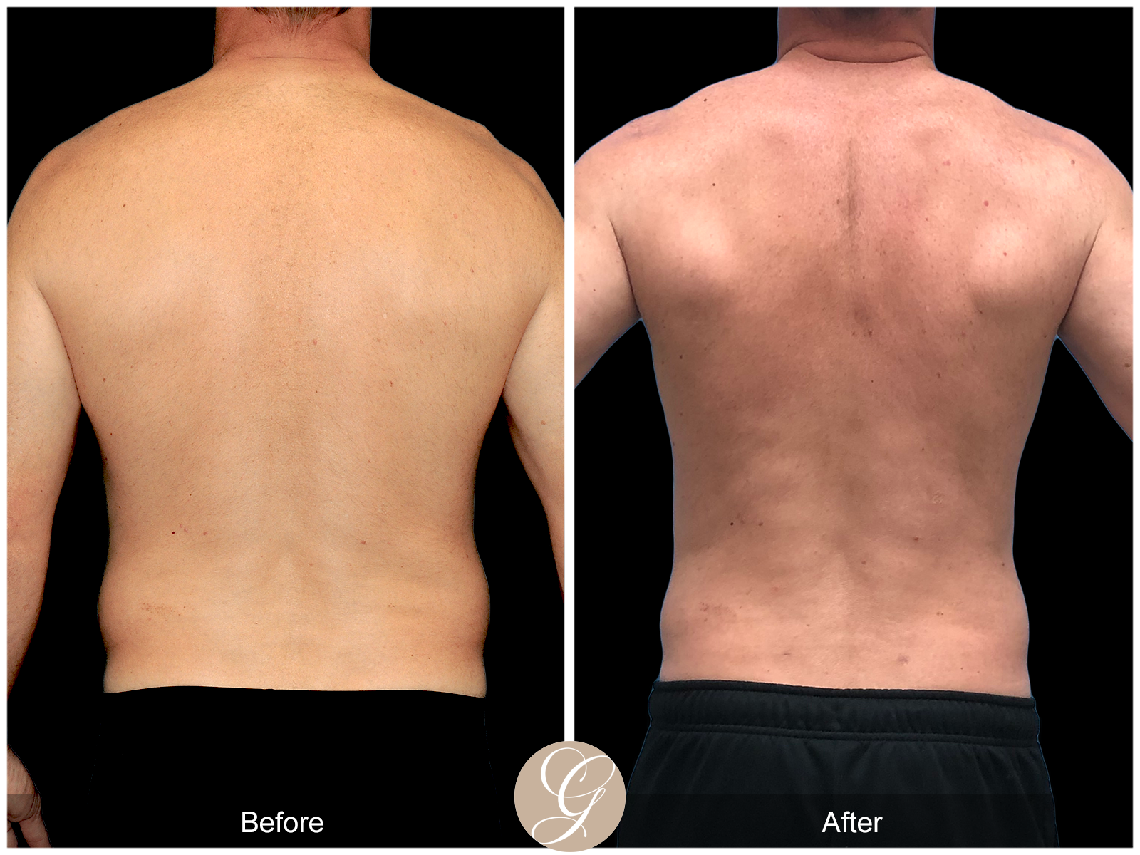 Gynecomastia PT3 Image