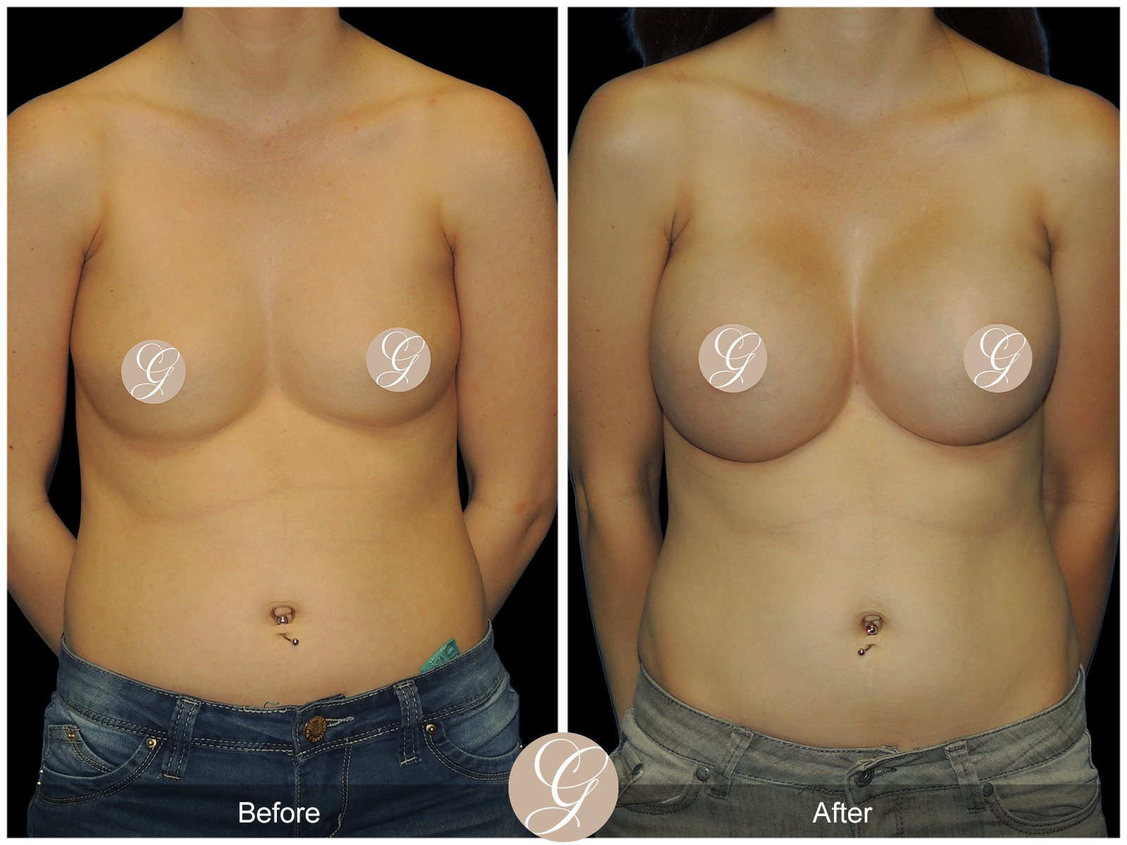 Breast Augmentation PT8 Image