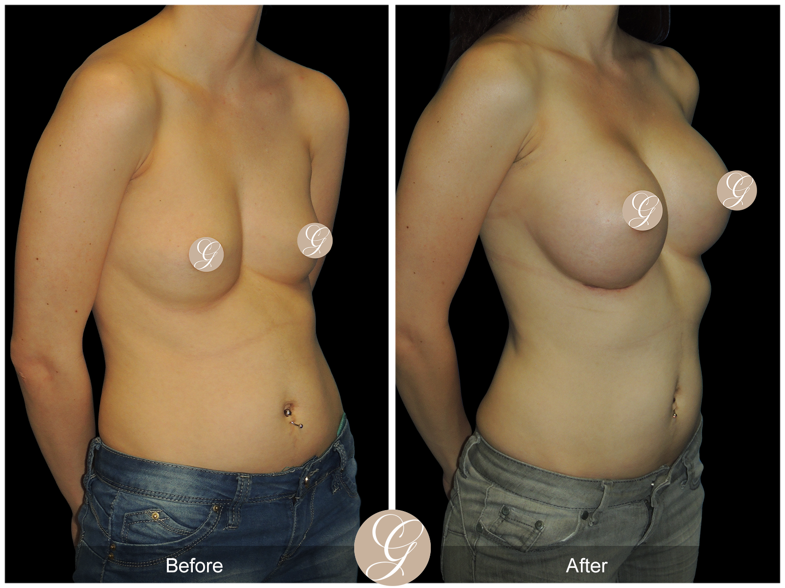 Breast Augmentation PT8 Image