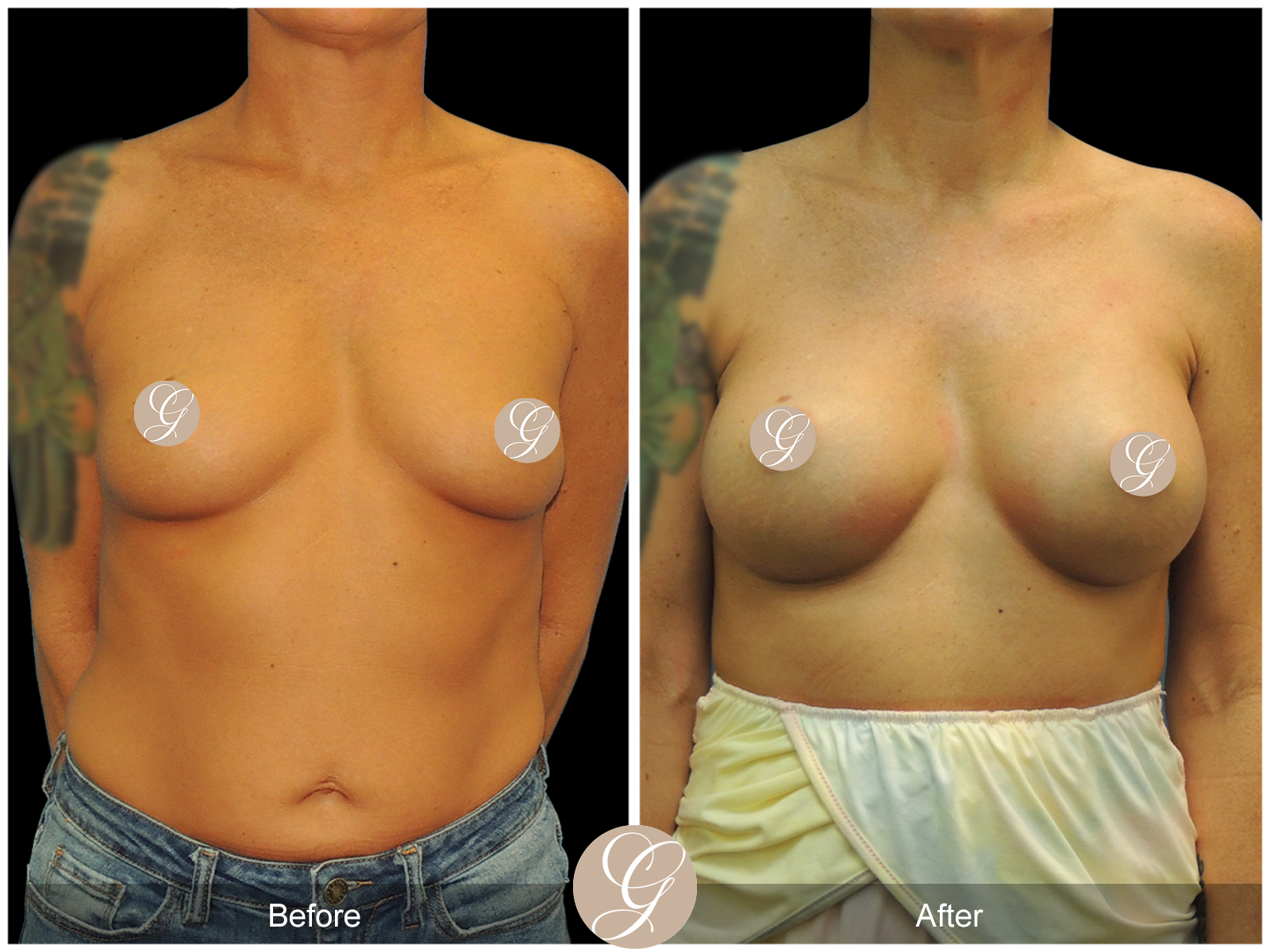 Breast Augmentation PT9 Image
