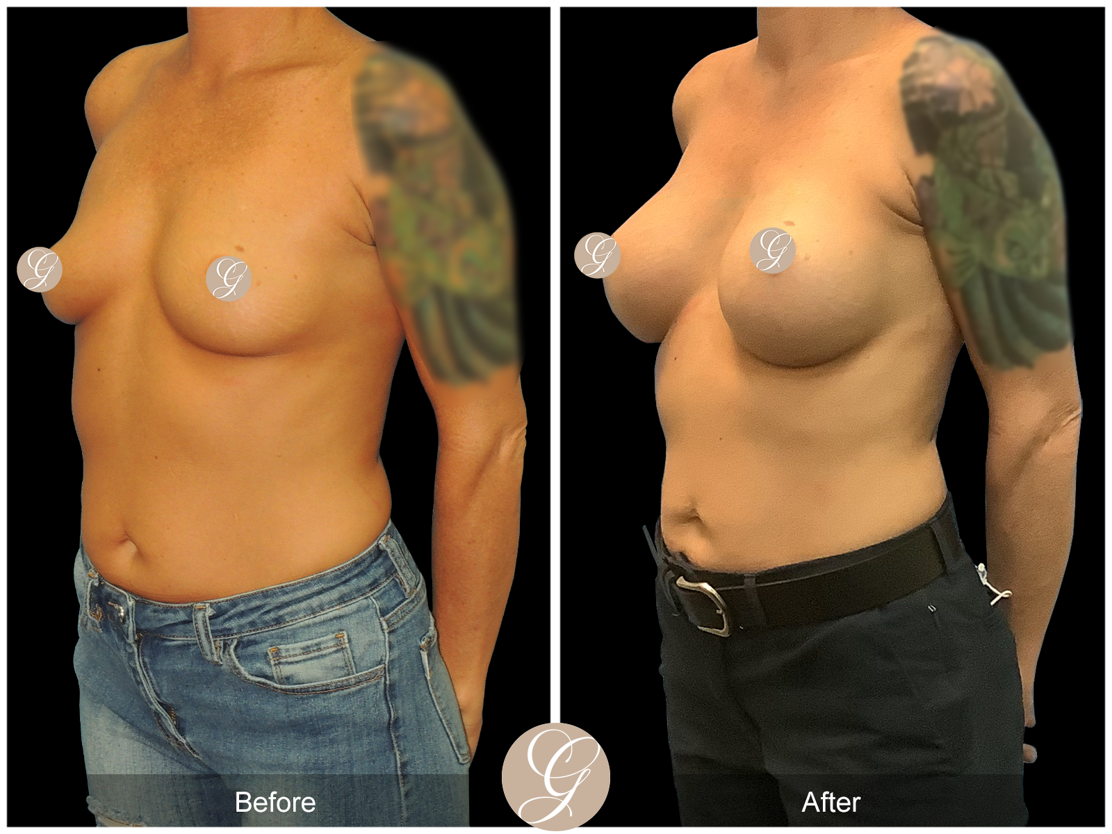 Breast Augmentation PT9 Image