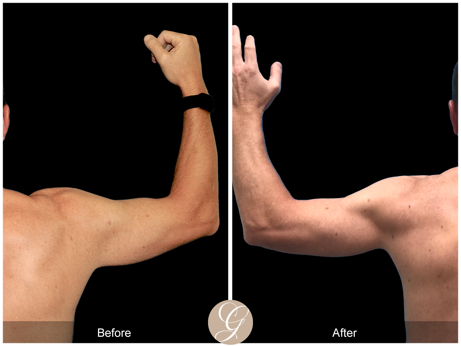 Gynecomastia PT3 Image