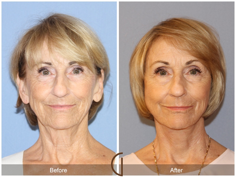 Natural Lift 421 Image