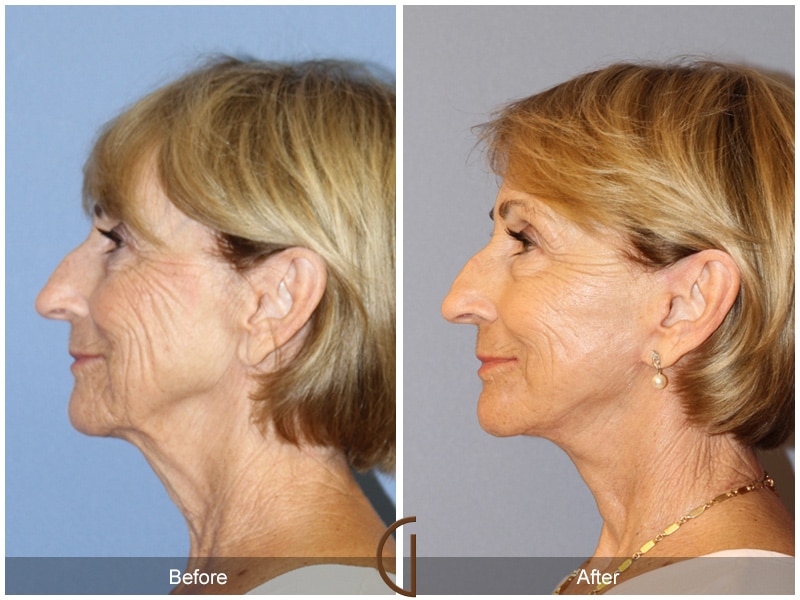 Natural Lift 421 Image