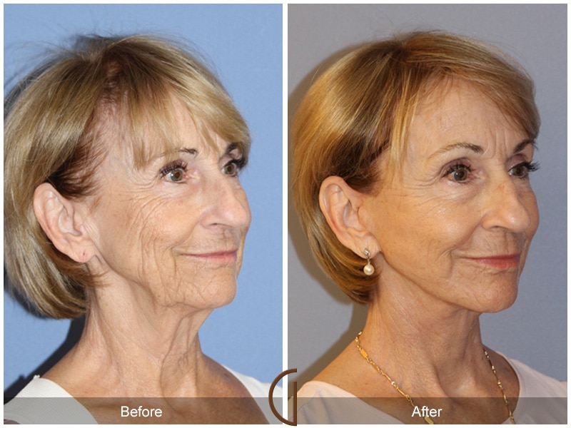 Natural Lift 421 Image
