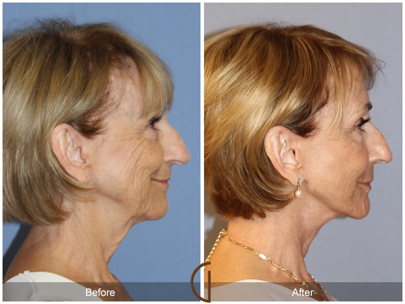 Natural Lift 421 Image