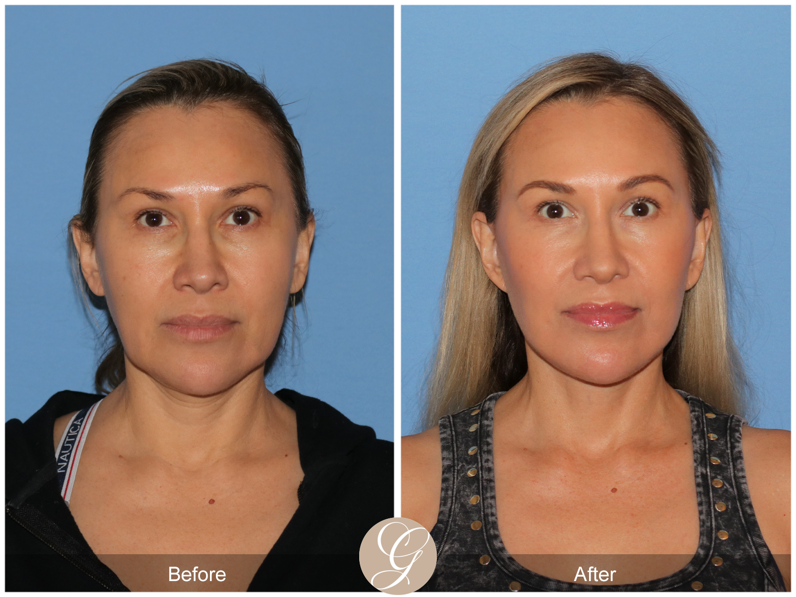 Preservation Facelift Case 18 Image